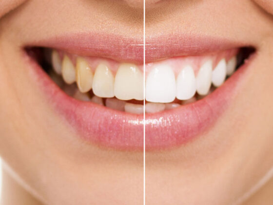 Brighten Your Smile, Boost Your Confidence – Direct Teeth Whitening
