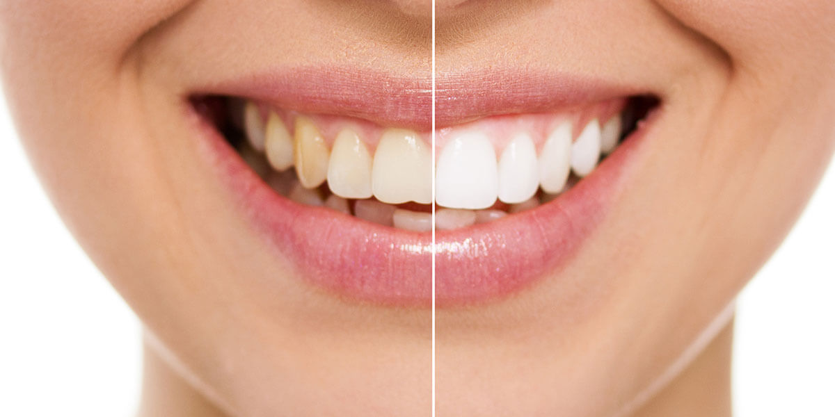 Brighten Your Smile, Boost Your Confidence – Direct Teeth Whitening