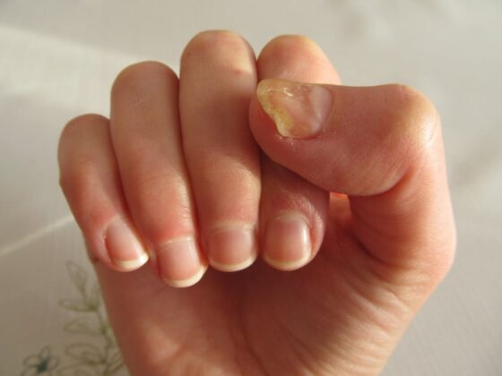 How to Tackle Fungal Infections with Oxford Online Pharmacy